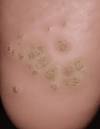 The Truth Behind Safely Treating &amp; Removing Plantar Warts