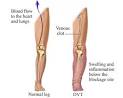 Deep Vein Thrombosis - Anytime Health