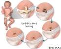 <b>Umbilical</b> care