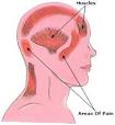 Headache Cures, Causes, Relief | Natural Headache Remedies, Treatment