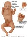Patau Syndrome Trisomy 13