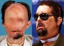 first full face transplant