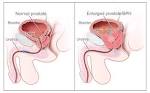 File:Benign Prostatic Hyperplasia nci-vol-7137-300.jpg - Wikipedia ...