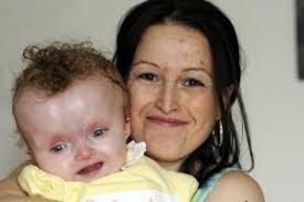 APPEAL: Caroline MacDonald with Angel-May, who has Dandy-Walker Syndrome