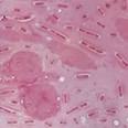 Bacteremia and Sepsis