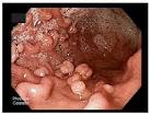 PCSG - Journal Watch - Gastric polyps