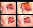 Nose Diagnosis - EPISTAXIS (Nose Bleeding) | Foreign Body ...