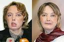 Even though face transplant is