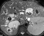 <b>Caroli disease</b>.