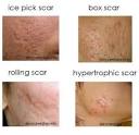  Alternative Acne Scars Treatment