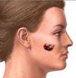 Malignant melanoma