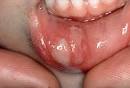Apthous Ulcers (Mouth Ulcers)-RAD — Dr Paulose