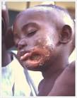 Young Survivor of Noma