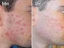  Is Laser Acne Treatment Permanent?