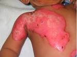 Emergency and early management of burns and scalds | BMJ