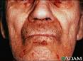 What Causes Amyloidosis? - HealthCentral