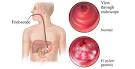 Medicina – Health | AKUTNI GASTRITIS UDRUŽEN S H. PYLORI