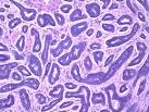 Slide: <b>Adenoid Cystic</b>