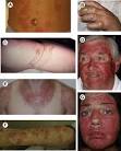 The linear areas of this rash