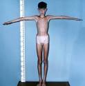 Klinefelter's syndrome
