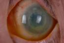 Corneal Transplant