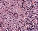 File:Granulation tissue containg a poorly formed granuloma with a ...