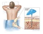 Lymphoblastic <b>Leukemia</b>
