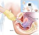 Vaginal Ultrasound Required for Abortion in Texas