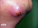 Staph (Staff) Skin Infections Pictures | Healthhype.