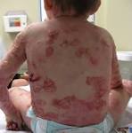 <b>ichthyosiform erythroderma</b>