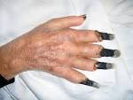 Digital <b>Gangrene</b>