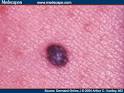 A typical <b>pigmented</b>