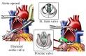 Aortic Valve Replacement Repair Surgery