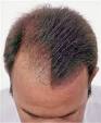 Hair Loss Concealers - Hair Loss Sprays, Hair Loss Lotions, Hair ...