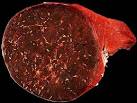 Slide: Hamartoma of Spleen | Webpathology.