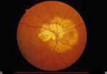 EyeAtlas -- <b>Choroidal</b> osteoma