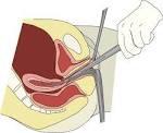File:Dilation &amp; curettage.svg - Wikipedia, the free encyclopedia