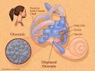 BPPV -- Benign Paroxysmal Positional Vertigo