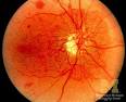 The Eyes Have It: Optic Fundus Signs