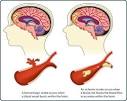 CDC - DHDSP - Types of Stroke