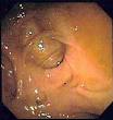 Diverticulosis - Wikipedia, the free encyclopedia