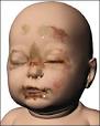 Baby P's head injuries,