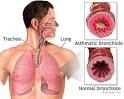 Asthma - In-Depth Report - NY Times Health