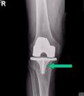 <b>Osteolysis</b> around a total knee