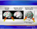 <b>Dyslexia</b> and Fast ForWord®