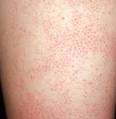 KERATOSIS PILARIS Treatment | Dermatology Care of Charlotte