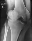 <b>dislocated patella</b>