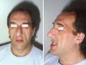 File:Acromegaly <b>prognathism</b>.
