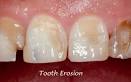 La <b>erosión dental</b>