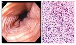 Eosinophilic Esophagitis — NEJM